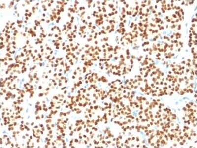 Immunohistochemistry-Paraffin: PAX8 Antibody (PAX8/1491) - Azide and BSA Free [NBP2-54486] - Formalin-fixed, paraffin-embedded human thyroid carcinoma stained with PAX8 Antibody (PAX8/1491).
