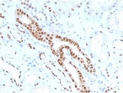 Immunohistochemistry-Paraffin: PAX8 Antibody (PAX8/1491) - Azide and BSA Free [NBP2-54486] - Formalin-fixed, paraffin-embedded human Renal Cell Carcinoma stained with PAX8 Antibody (PAX8/1491).