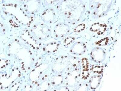 Immunohistochemistry-Paraffin: PAX8 Antibody (PAX8/1492) - Azide and BSA Free [NBP2-54539] - Formalin-fixed, paraffin-embedded human Renal Cell Carcinoma stained with PAX8 Monoclonal Antibody (PAX8/1492).