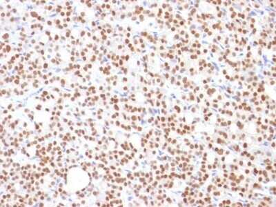 Immunohistochemistry-Paraffin: PAX8 Antibody (PAX8/1492) - Azide and BSA Free [NBP2-54539] - Formalin-fixed, paraffin-embedded human Thyroid Carcinoma stained with PAX8 Monoclonal Antibody (PAX8/1492).