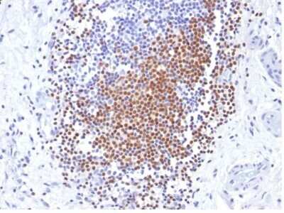 Immunohistochemistry-Paraffin: PAX8 Antibody (PAX8/1492) - Azide and BSA Free [NBP2-54539] - Formalin-fixed, paraffin-embedded human Urothelial Carcinoma stained with PAX8 Monoclonal Antibody (PAX8/1492).