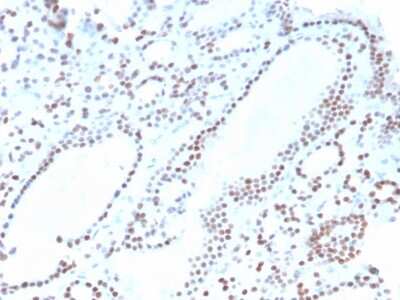 Immunohistochemistry-Paraffin: PAX8 Antibody (ZR-1) [NBP3-07361] - Formalin-fixed, paraffin-embedded human thyroid stained with PAX8 Recombinant Rabbit Monoclonal Antibody (ZR-1).