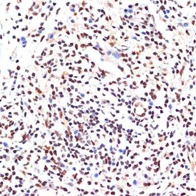 Immunohistochemistry-Paraffin: PAX9 Antibody (3C2U5) [NBP3-15888] - Human breast cancer using PAX9 Rabbit mAb (NBP3-15888) at dilution of 1:100 (40x lens).Perform microwave antigen retrieval with 10 mM Tris/EDTA buffer pH 9.0 before commencing with IHC staining protocol.