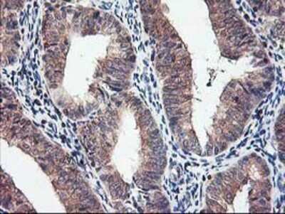 Immunohistochemistry: PBDC1 Antibody (OTI4E11) - Azide and BSA Free [NBP2-71912] - Staining of paraffin-embedded Adenocarcinoma of Human endometrium tissue using anti-CXorf26 mouse monoclonal antibody.