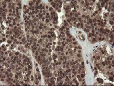 Immunohistochemistry: PBDC1 Antibody (OTI5A11) - Azide and BSA Free [NBP2-71911] - Analysis of Carcinoma of Human pancreas tissue.