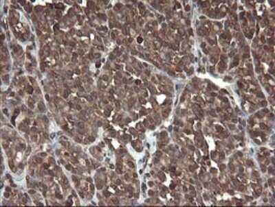 Immunohistochemistry: PBDC1 Antibody (OTI5A11) - Azide and BSA Free [NBP2-71911] - Analysis of Carcinoma of Human thyroid tissue.
