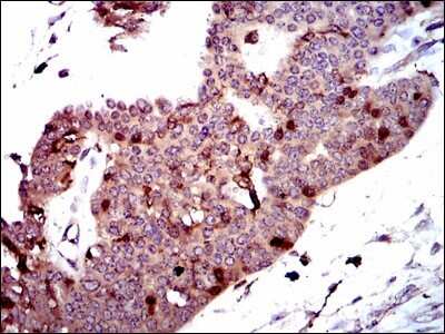 Immunohistochemistry: PBK Antibody (2C8) [NBP2-37514] - Immunohistochemical analysis of paraffin-embedded ovarian cancer tissues using PBK mouse mAb with DAB staining.