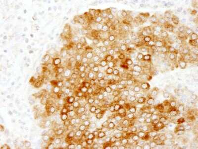 <b>Independent Antibodies Validation. </b>Immunohistochemistry-Paraffin: PBXIP1 Antibody [NB100-81652] - Human pancreatic islet cell tumor.  Antibody used at a dilution of 1:200.