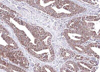 Immunohistochemistry-Paraffin: PCCB Antibody [NBP1-31464] - Paraffin-embedded Lung Ad Cancer PC14 xenograft, using antibody at 1:100 dilution.