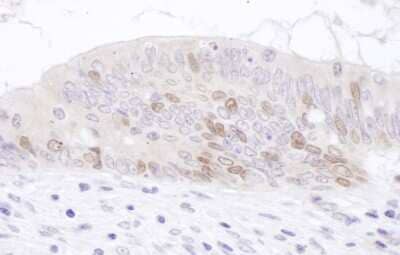 Immunohistochemistry-Paraffin: PCNA associated factor Antibody [NBP2-32117] - Section of human prostate carcinoma. Antibody: Affinity purified rabbit anti- PAF used at a dilution of 1:1,000 (1ug/ml). Detection: DAB. Counterstain: IHC Hematoxylin (blue).