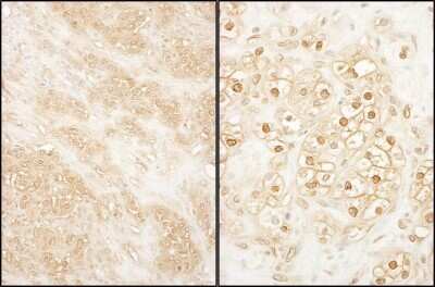 <b>Biological Strategies Validation. </b>Immunohistochemistry-Paraffin: PCTAIRE2 Antibody [NBP1-42688] - Sample: FFPE section of human breast carcinoma (left) and kidney clear cell carcinoma (right). Antibody: Affinity purified rabbit anti- PCTAIRE 2 used at a dilution of 1:1,000 (1ug/ml). Detection: DAB