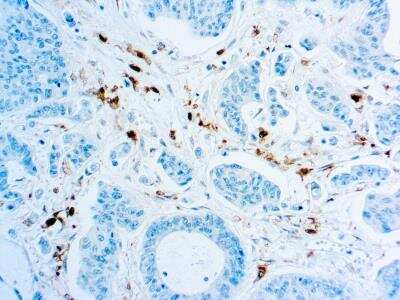 Immunohistochemistry-Paraffin: PD-ECGF/Thymidine Phosphorylase Antibody (P-GF.44C) [NBP2-26443] - Formalin fixed paraffin embedded colon carcinoma stained with Thymidine phosphorylase antibody (NBP2-26443).