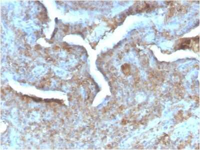 Immunohistochemistry-Paraffin: PD-ECGF/Thymidine Phosphorylase Antibody (TYMP/2890R) - Azide and BSA Free [NBP3-08402] - Formalin-fixed, paraffin-embedded human Prostate Carcinoma stained with PD-ECGF/Thymidine Phosphorylase Rabbit Recombinant Monoclonal (TYMP/2890R).