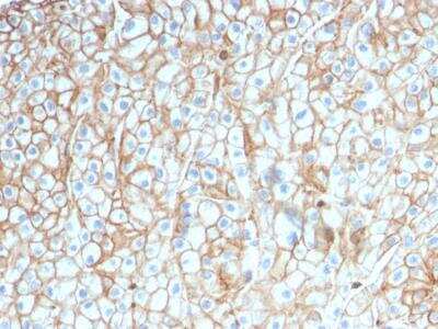 Immunohistochemistry-Paraffin: PD-L1 Antibody (PDL1/2746) [NBP2-80490] - Formalin-fixed, paraffin-embedded human Lung SCC stained with PD-L1 Antibody (PDL1/2746).
