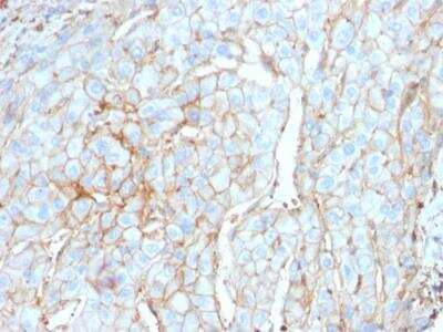 Immunohistochemistry-Paraffin: PD-L1 Antibody (PDL1/2746) [NBP2-80490] - Formalin-fixed, paraffin-embedded human Cervical Carcinoma stained with PD-L1 Antibody (PDL1/2746).