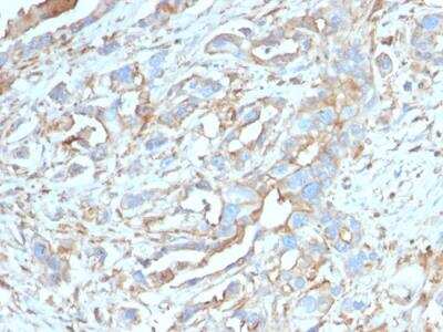 Immunohistochemistry-Paraffin: PD-L1 Antibody (PDL1/2746) [NBP2-80490] - Formalin-fixed, paraffin-embedded human Breast Carcinoma stained with PD-L1 Antibody (PDL1/2746).