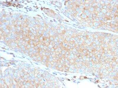 Immunohistochemistry-Paraffin: PD-L1 Antibody (PDL1/2746) [NBP2-80490] - Formalin-fixed, paraffin-embedded human Basal Cell Carcinoma stained with PD-L1 Antibody (PDL1/2746).