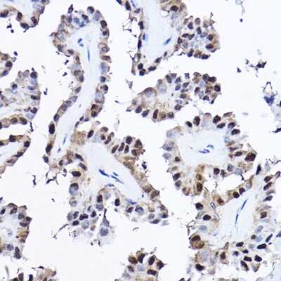 Immunohistochemistry-Paraffin: PDCD4 Antibody [NBP3-03401] - Immunohistochemistry of paraffin-embedded human thyroid cancer using [KO Validated] PDCD4 Rabbit pAb (NBP3-03401) at dilution of 1:25 (40x lens). Perform high pressure antigen retrieval with 10 mM citrate buffer pH 6.0 before commencing with IHC staining protocol.