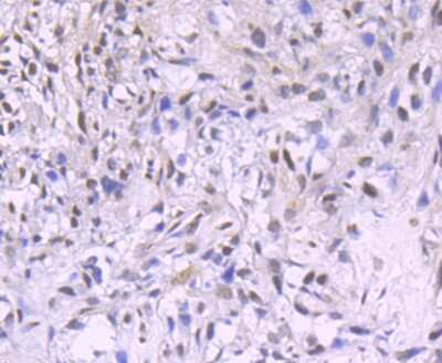 Immunohistochemistry-Paraffin: PDCD4 Antibody (JA80-83) [NBP2-67024] - Analysis of paraffin-embedded human breast cancer tissue using anti-PDCD4 antibody. Counter stained with hematoxylin.