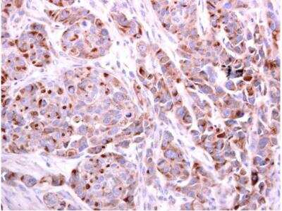 Immunohistochemistry-Paraffin: PDCD6 Antibody [NBP2-19741] - Human colon carcinoma. PDCD6 antibody diluted at 1:500. Antigen Retrieval: Trilogy™ (EDTA based, pH 8.0) buffer, 15min