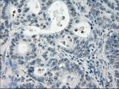 Immunohistochemistry-Paraffin: PDE10A Antibody (1C9) [NBP1-47909] - Staining of paraffin-embedded Adenocarcinoma of colon tissue using anti-PDE10A mouse monoclonal antibody.