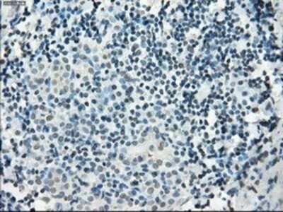 Immunohistochemistry: PDE10A Antibody (OTI1C9) - Azide and BSA Free [NBP2-73273] - Staining of paraffin-embedded Carcinoma of thyroid tissue using anti-PDE10A mouse monoclonal antibody.