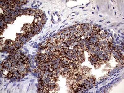 Immunohistochemistry: PDE1A Antibody (7D5) [NBP2-46355] - Analysis of Carcinoma of Human prostate tissue. (Heat-induced epitope retrieval by 1 mM EDTA in 10mM Tris, pH8.5, 120C for 3min)