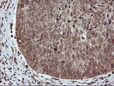 Immunohistochemistry-Paraffin: PDE4B Antibody (1D12) [NBP2-01171] - Staining of paraffin-embedded Carcinoma of Human bladder tissue using anti-PDE4B mouse monoclonal antibody.