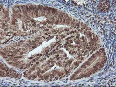 Immunohistochemistry: PDE4B Antibody (OTI1D12) - Azide and BSA Free [NBP2-73292] - Staining of paraffin-embedded Adenocarcinoma of Human endometrium tissue using anti-PDE4B mouse monoclonal antibody.