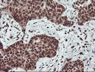 Immunohistochemistry: PDE4B Antibody (OTI1D12) - Azide and BSA Free [NBP2-73292] - Staining of paraffin-embedded Carcinoma of Human lung tissue using anti-PDE4B mouse monoclonal antibody.