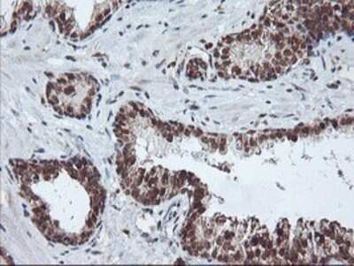 Immunohistochemistry: PDE4B Antibody (OTI1D12) - Azide and BSA Free [NBP2-73292] - Staining of paraffin-embedded Carcinoma of Human prostate tissue using anti-PDE4B mouse monoclonal antibody.