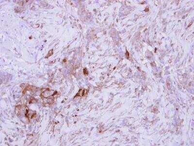 Immunohistochemistry-Paraffin: PDGF-B Antibody [NBP2-19748] -  Immunohistochemical analysis of paraffin-embedded Breast ca, using antibody at 1:250 dilution.