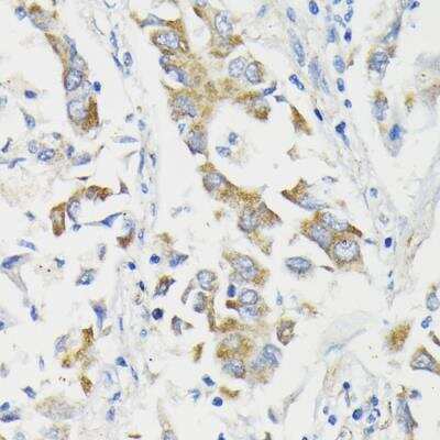 Immunohistochemistry-Paraffin: PDHA2 Antibody [NBP2-95269] - Immunohistochemistry microscopy image of paraffin embedded human lung cancer stained with Rabbit anti PDHA1 (NBP2-95269) at 1:200 dilution.