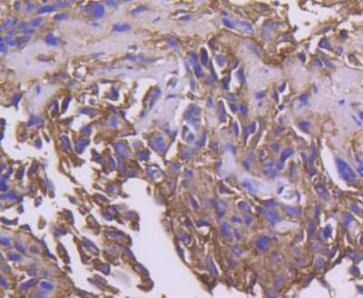 Immunohistochemistry-Paraffin: PDK-1 Antibody (SD204-9) [NBP2-67755] - Analysis of paraffin-embedded human breast carcinoma tissue using anti-PDPK1 antibody. Counter stained with hematoxylin.