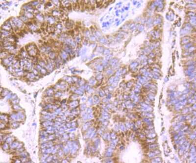 Immunohistochemistry-Paraffin: PDK2 Antibody (JB66-93) [NBP2-75611] - Analysis of paraffin-embedded human colon cancer tissue using anti-PDK2 antibody. Counter stained with hematoxylin.