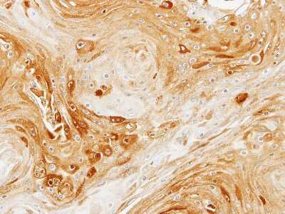 Immunohistochemistry-Paraffin: PDK3 Antibody [NBP1-32581] -  Ca922 xenograft, using PDK3 antibody at 1:100 dilution. Antigen Retrieval: Trilogy™ (EDTA based, pH 8.0) buffer, 15min