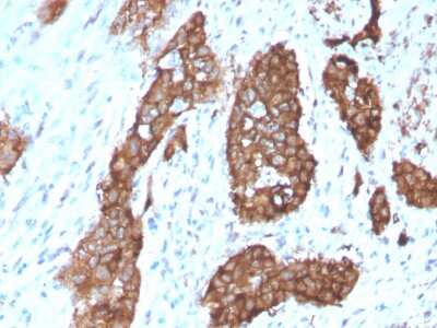 Immunohistochemistry-Paraffin: PDLIM1 Antibody (CPTC-PDLIM1-1) - Azide and BSA Free [NBP3-08842] - Formalin-fixed, paraffin-embedded human Breast Carcinoma stained with PDLIM1 Mouse Monoclonal Antibody (PDLIM-1).