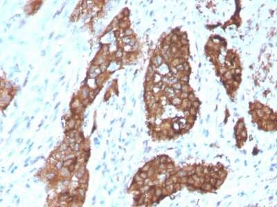 Immunohistochemistry-Paraffin: PDLIM1 Antibody (CPTC-PDLIM1-1) [NBP3-07518] - Formalin-fixed, paraffin-embedded human Breast Carcinoma stained with PDLIM1 Mouse Monoclonal Antibody (PDLIM-1).