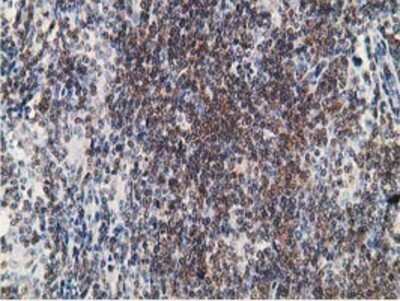 Immunohistochemistry-Paraffin: PDLIM2 Antibody (11A12) [NBP2-00619] - Staining of paraffin-embedded Human lymphoma tissue using anti-PDLIM2 mouse monoclonal antibody.