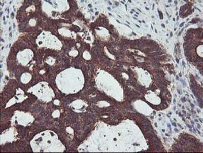 Immunohistochemistry: PDRG1 Antibody (OTI4F12) - Azide and BSA Free [NBP2-73320] - Staining of paraffin-embedded Adenocarcinoma of Human colon tissue using anti-PDRG1 mouse monoclonal antibody.