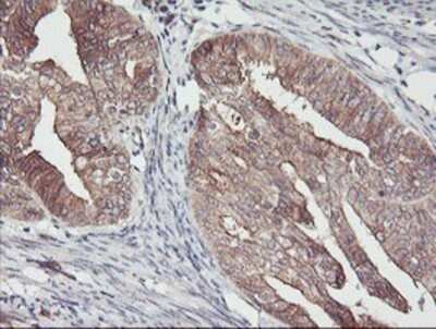 Immunohistochemistry: PDRG1 Antibody (OTI4F12) - Azide and BSA Free [NBP2-73320] - Staining of paraffin-embedded Adenocarcinoma of Human endometrium tissue using anti-PDRG1 mouse monoclonal antibody.