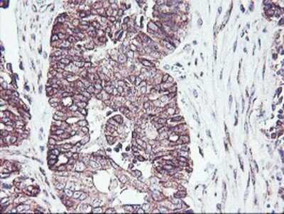 Immunohistochemistry: PDRG1 Antibody (OTI4F12) - Azide and BSA Free [NBP2-73320] - Staining of paraffin-embedded Adenocarcinoma of Human ovary tissue using anti-PDRG1 mouse monoclonal antibody.