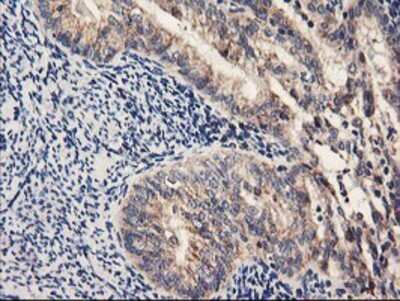 Immunohistochemistry: PDSS2 Antibody (OTI1D12) - Azide and BSA Free [NBP2-73323] - Staining of paraffin-embedded Adenocarcinoma of Human endometrium tissue using anti-PDSS2 mouse monoclonal antibody.