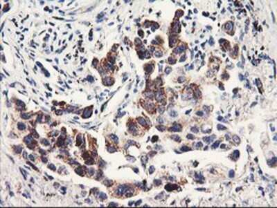 Immunohistochemistry: PDSS2 Antibody (OTI1D12) - Azide and BSA Free [NBP2-73323] - Staining of paraffin-embedded Carcinoma of Human lung tissue using anti-PDSS2 mouse monoclonal antibody.