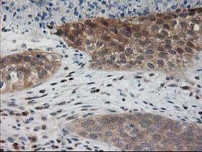 Immunohistochemistry-Paraffin: PDXK Antibody (5H5) [NBP2-00821] - Staining of paraffin-embedded Carcinoma of Human bladder tissue using anti-PDXK mouse monoclonal antibody.