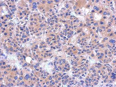 Immunohistochemistry-Paraffin: PDZRN4 Antibody [NBP2-19762] - Immunohistochemical analysis of paraffin-embedded hepatoma, using antibody at 1:500 dilution.
