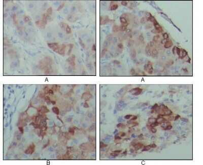 Immunohistochemistry-Paraffin: PEG10 Antibody (4C10A7) [NBP1-28900] - Immunohistochemical analysis of paraffin-embedded human hepatocarcinoma (A), breast carcinoma (B) and lung cancer tissues (C), showing cytoplasmic localization with DAB staining using PEG10 mouse mAb.