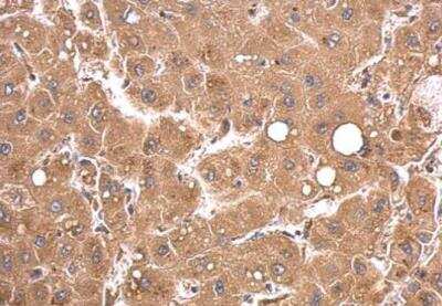 Immunohistochemistry-Paraffin: PEX5 Antibody [NBP1-32782] - Paraffin-embedded hepatoma. PEX5 antibody  dilution: 1:500.