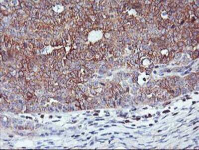 Immunohistochemistry: PFDN6 Antibody (OTI4E10) - Azide and BSA Free [NBP2-73339] - Staining of paraffin-embedded Adenocarcinoma of Human ovary tissue using anti-PFDN6 mouse monoclonal antibody.