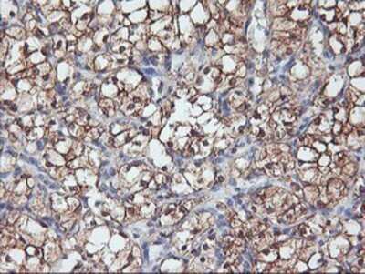 Immunohistochemistry: PFDN6 Antibody (OTI4E10) - Azide and BSA Free [NBP2-73339] - Staining of paraffin-embedded Carcinoma of Human kidney tissue using anti-PFDN6 mouse monoclonal antibody.